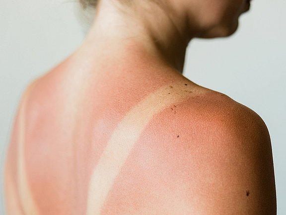 Die Haut reagiert auf übermäßige Sonneneinstrahlung mit einem Sonnenbrand. Es handelt sich um eine akute Entzündung der Haut als Reaktion auf die energiereiche UV-Strahlung der Sonne.