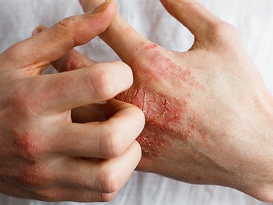 Ekzem ist ein Sammelbegriff für nicht infektiöse und somit auch nicht ansteckende, entzündliche Hautreaktionen.